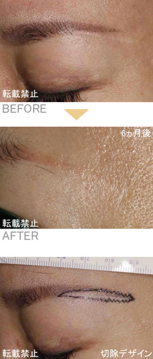 眉毛下皮膚切除(眉下リフト、眉下切除)の傷跡の修正