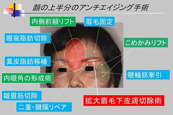 まぶたのタルミ　眉下切開　二重・腱膜リペア